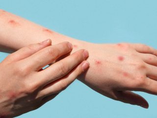 Alerta sanitaria por posible contagio de sarampión en concierto de Nueva Jersey